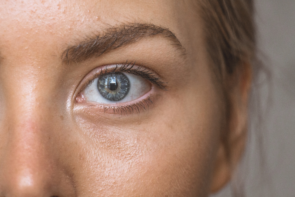 Managing Acne With Nutrition And Lifestyle 1