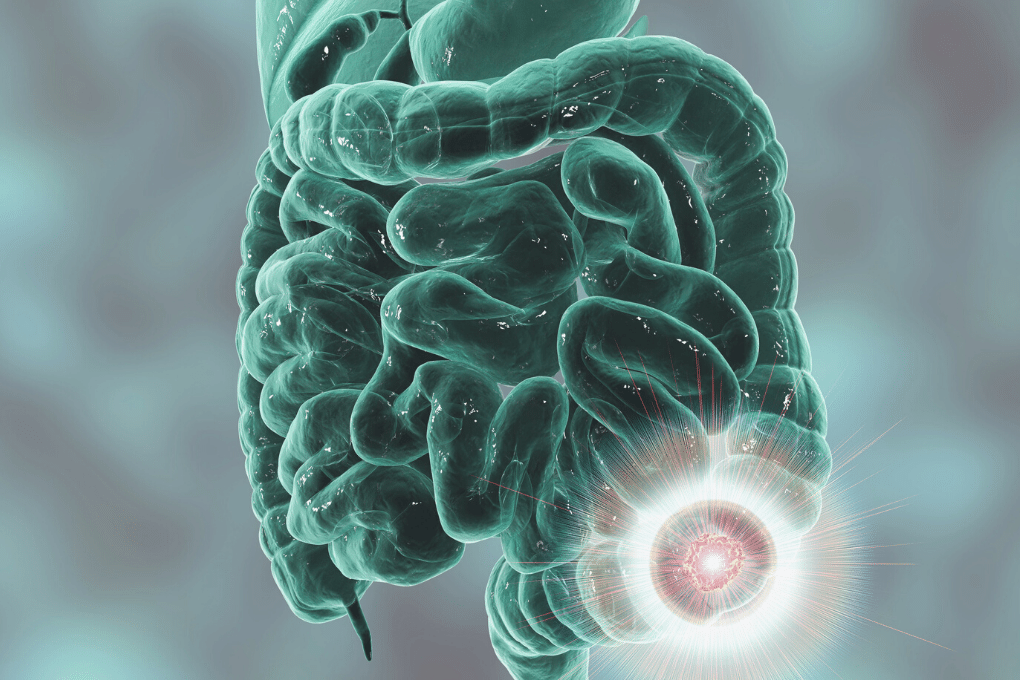 Bowel Cancer